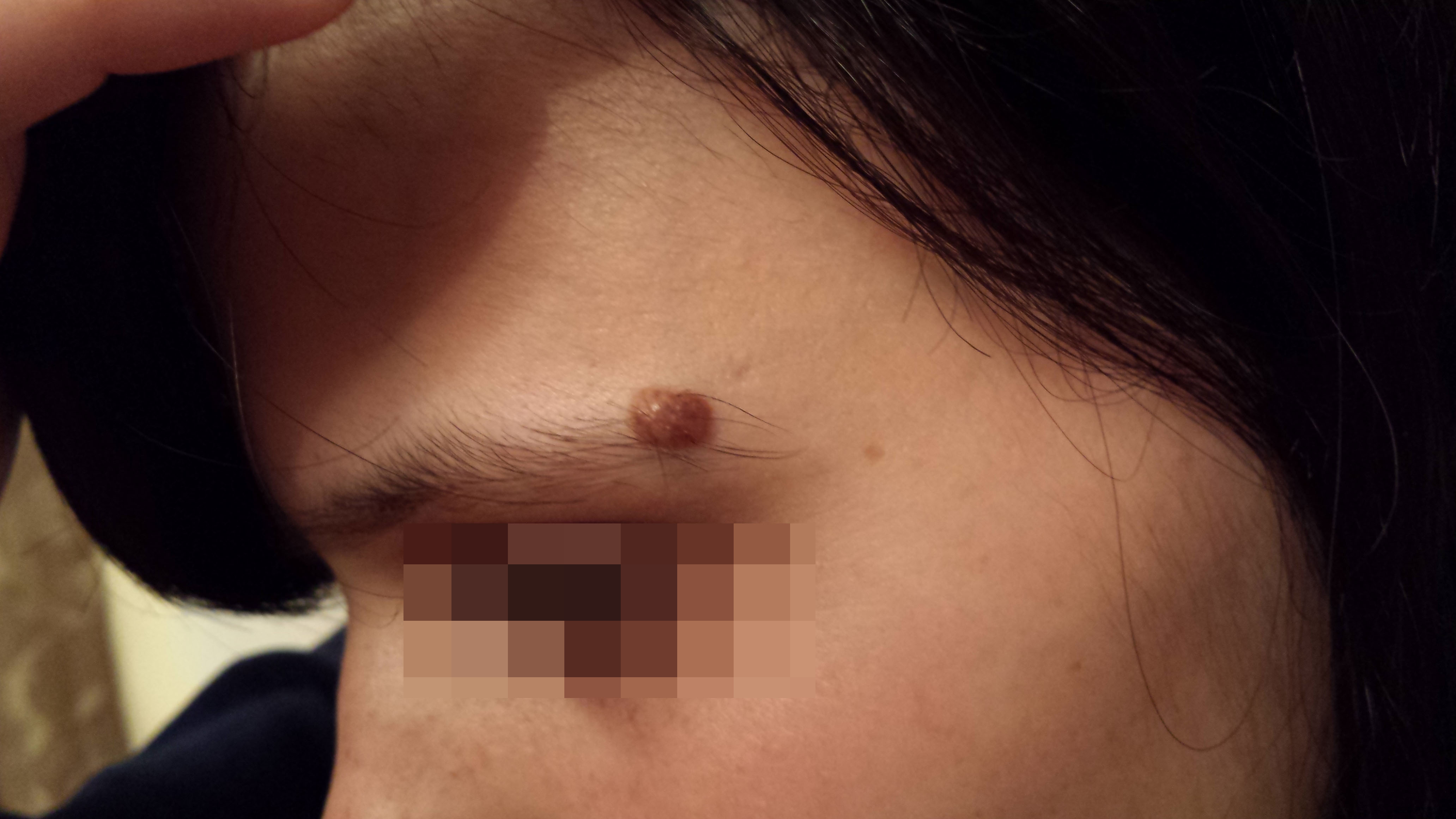 Causes Of Moles And Its Effect On Body High Precision Dermatology Centre