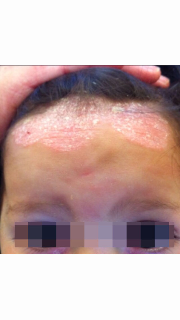 A short guide on Psoriasis Skin Condition High Precision