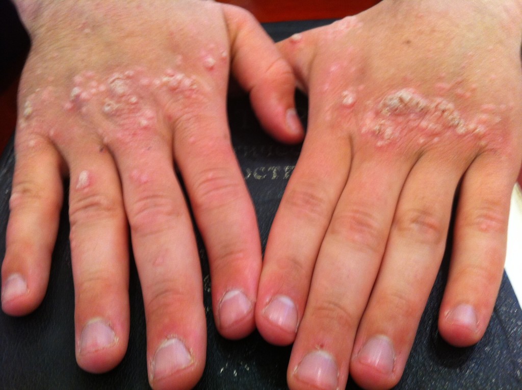 warts on hands eczema)